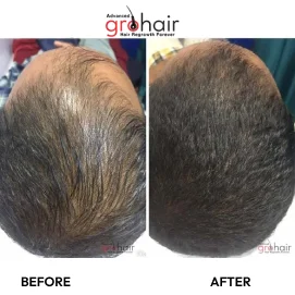 hair loss treatment