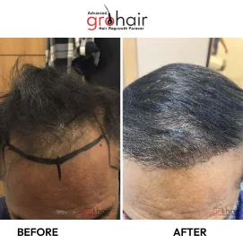 scalp micropigmentation