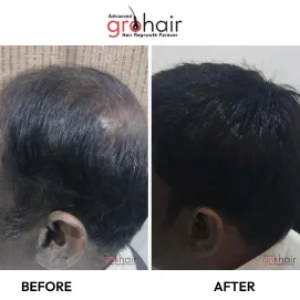 hair transplant in nellore