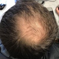 hair loss